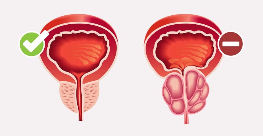 Weiprost normalise la taille et la fonction de la prostate