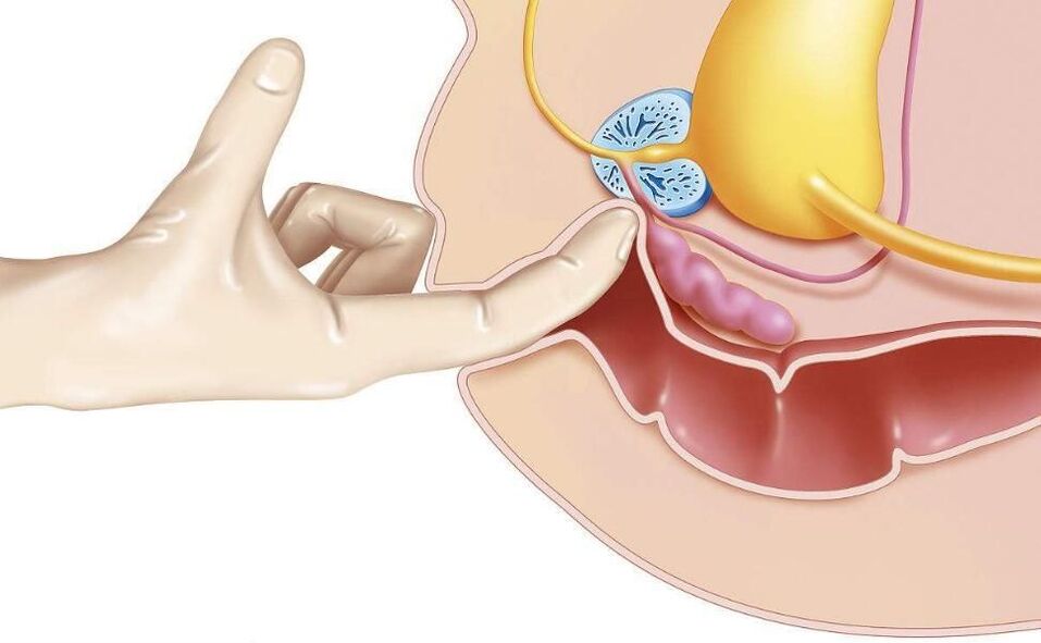 Massage de la prostate pour le traitement de la prostatite