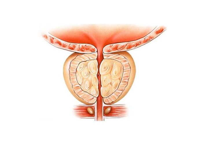 inflammation de la prostate