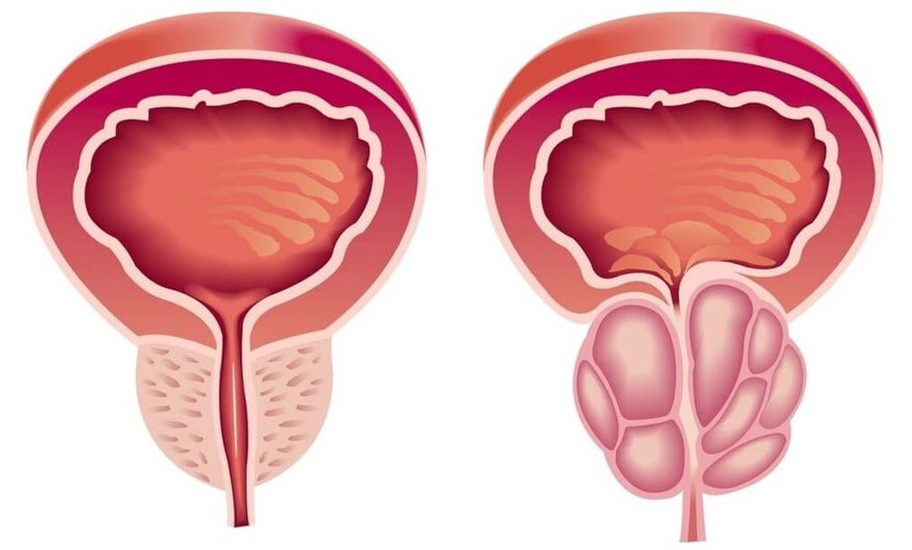 prostate saine et malade