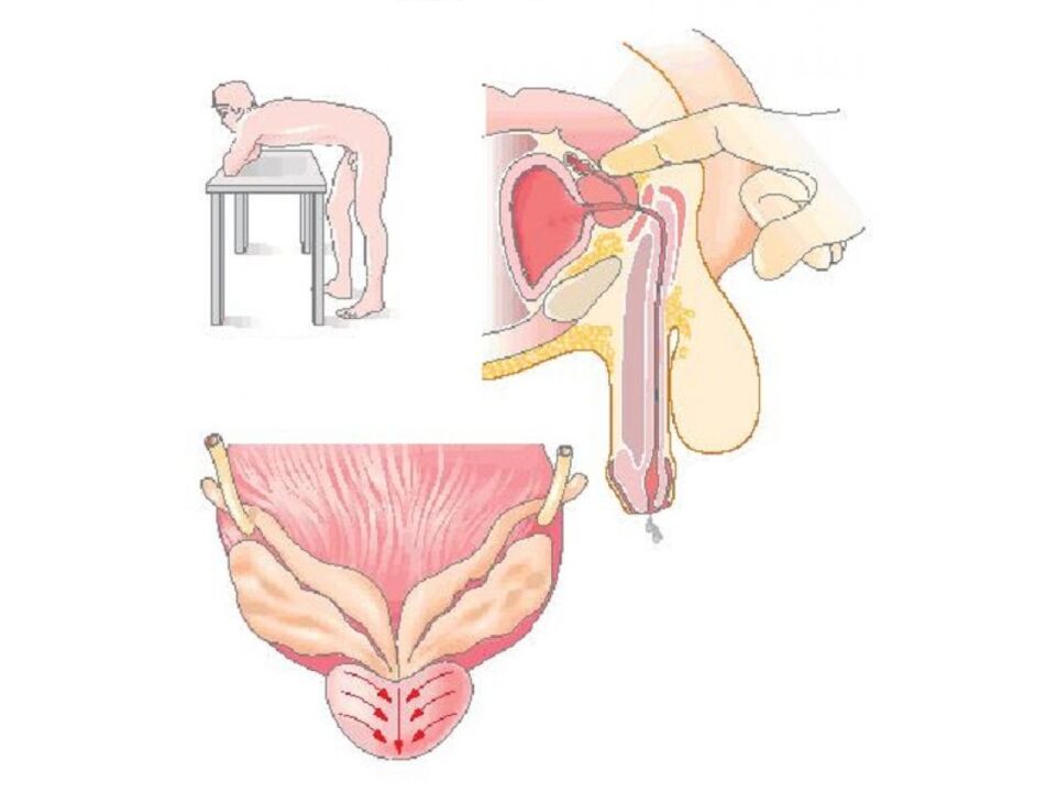 Technique de massage de la prostate par un médecin pour analyser la sécrétion